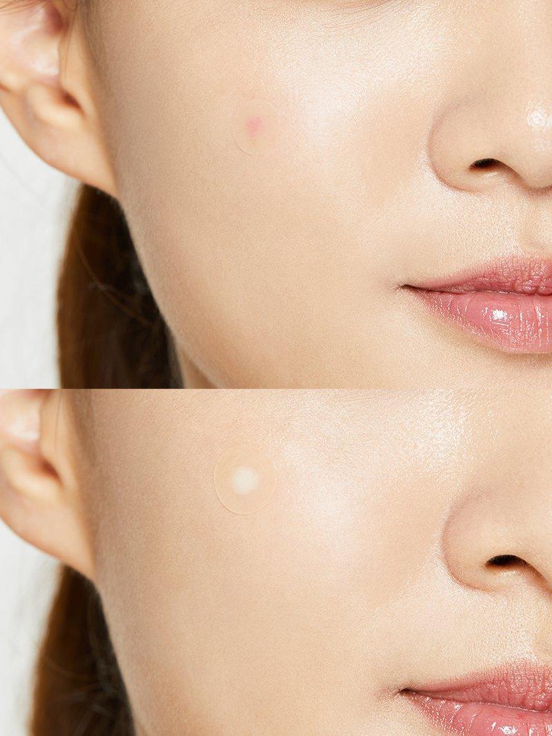 ($60+ Free Gift) Acne Pimple Master Patch