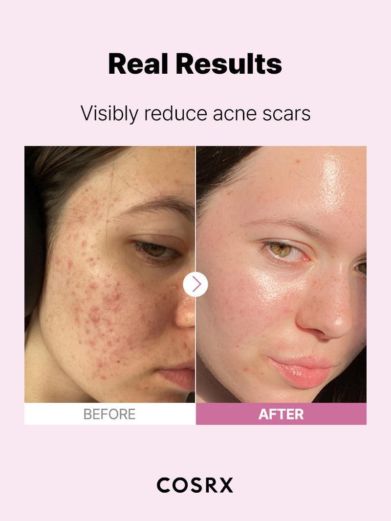 24-HR Synergy Duo (Acne Free)